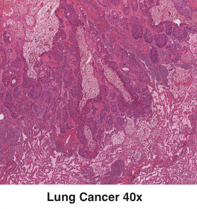 Lung Cancer2