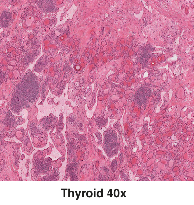 Thyroid2